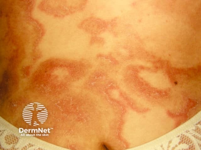 Annular erythema