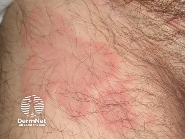 Erythema annulare centrifugum