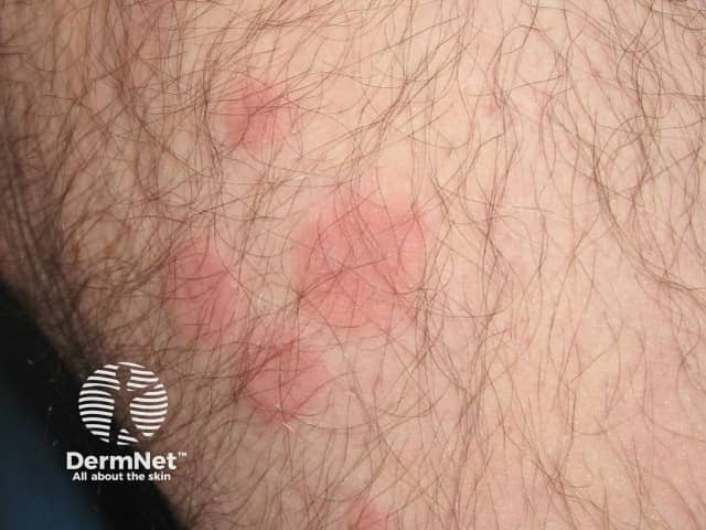 Annular erythema