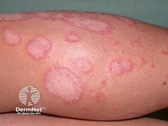 Erythema annulare centrifugum