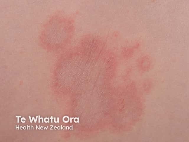 Erythema annulare centrifugum