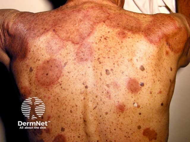 Erythema annulare centrifugum