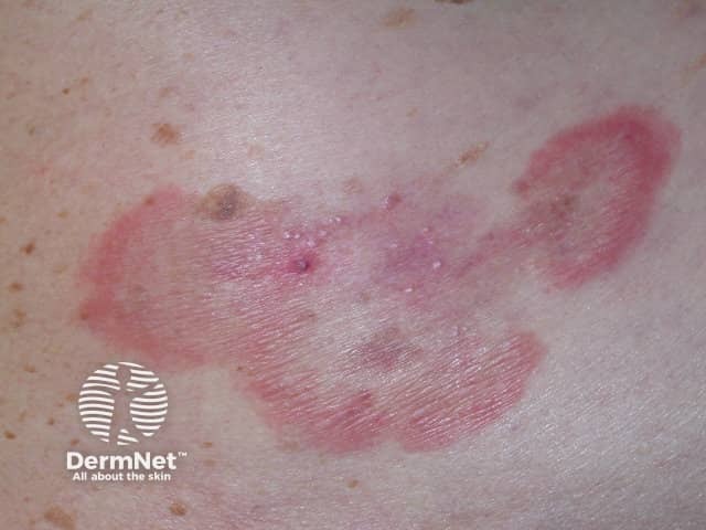 Annular erythema