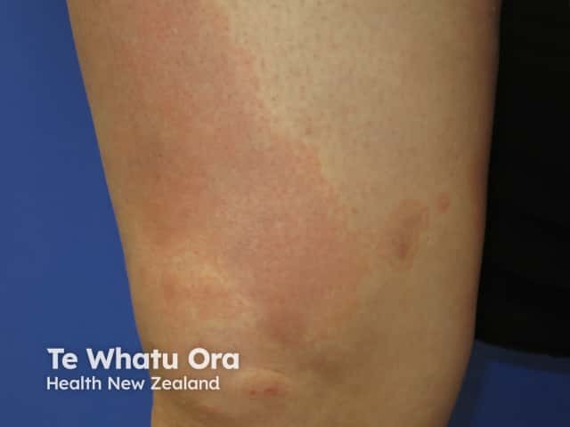 Erythema annulare centrifugum