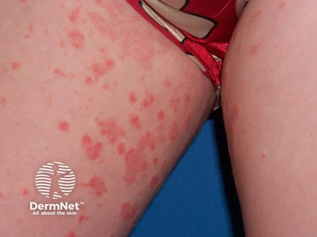 Erythema annulare