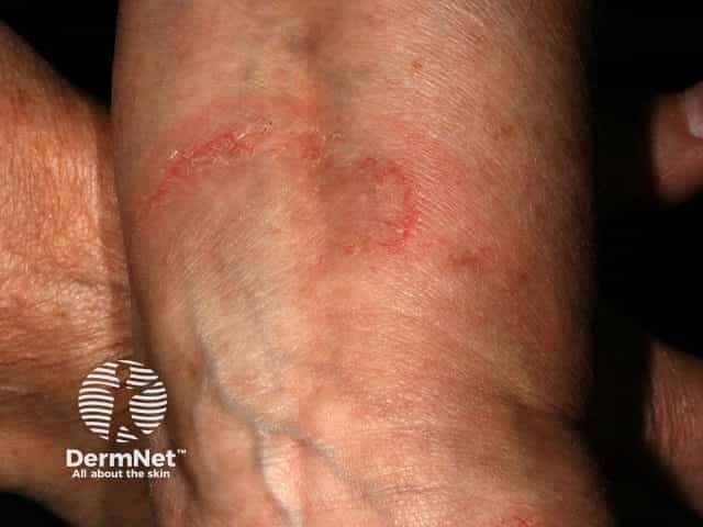 Erythema annulare centrifugum