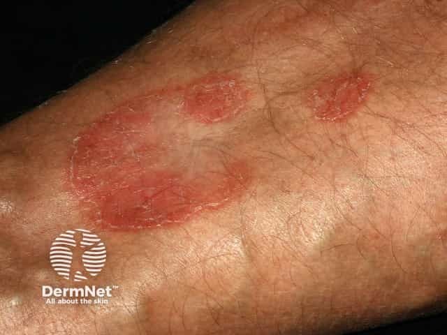 Erythema annulare centrifugum