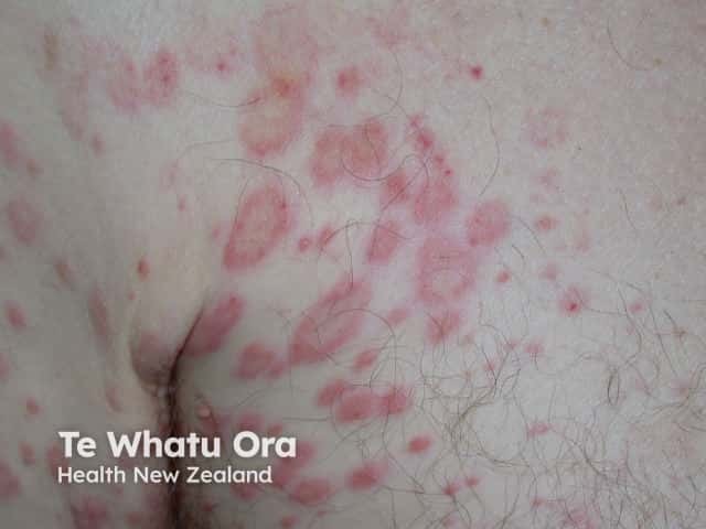 Erythema annulare centrifugum