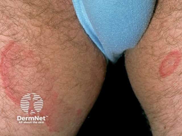 Erythema annulare centrifugum