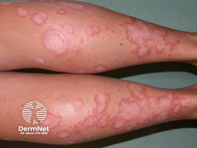 Erythema annulare centrifugum