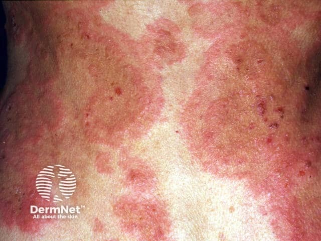 Erythema annulare centrifugum