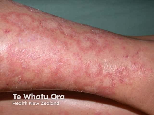 Erythema annulare centrifugum