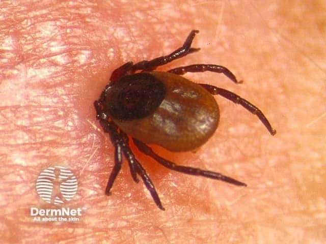 Tick bite