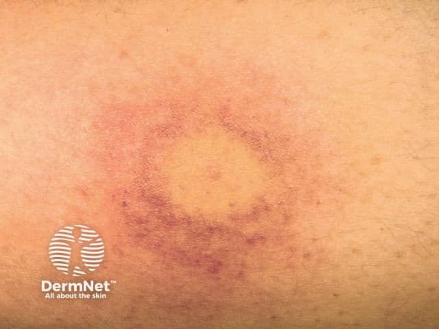 Wasp sting reaction causing localised vasculitis with purpura