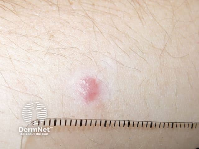 Wasp sting reaction persisted for more than 6 weeks