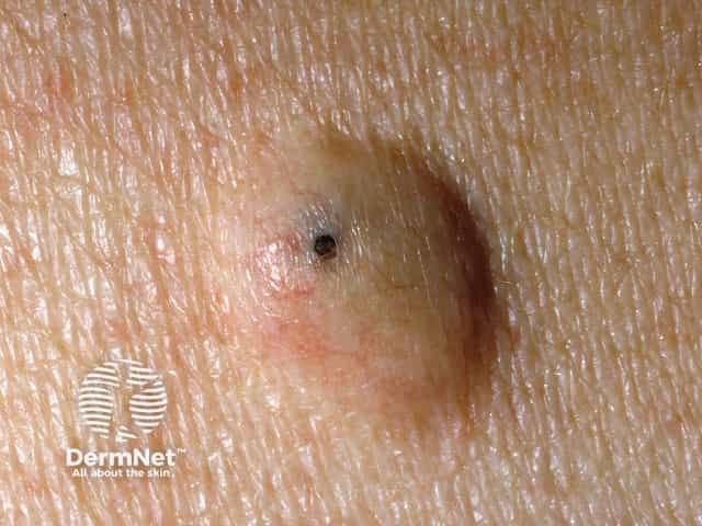 Epidermoid cyst