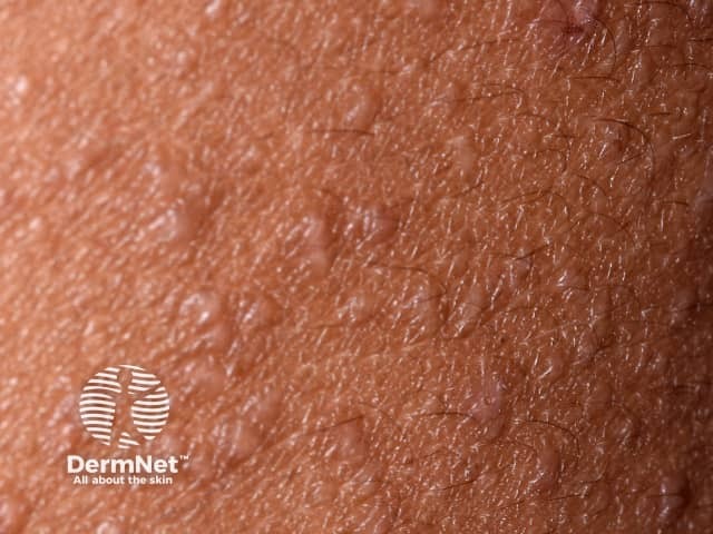 Close-up of follicular atopic dermatitis