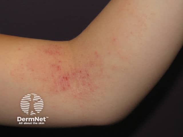 Atopic eczema