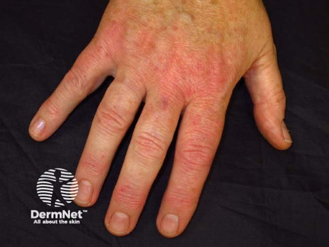 Irritant contact dermatitis