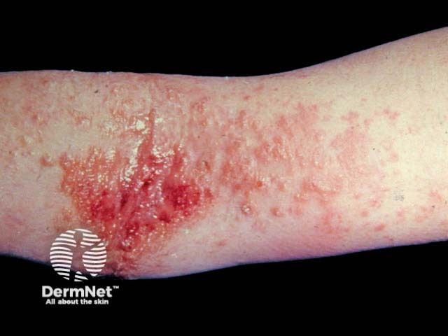 Atopic eczema