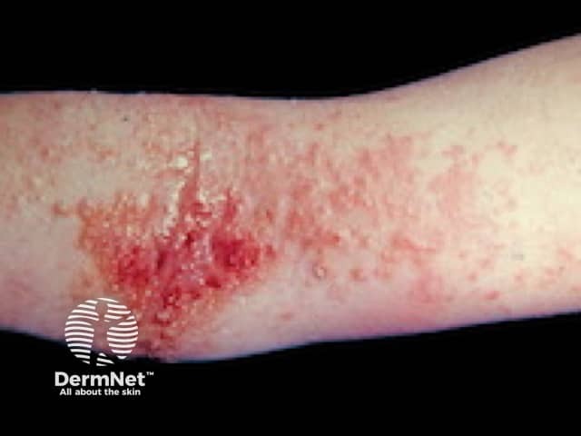 Atopic eczema