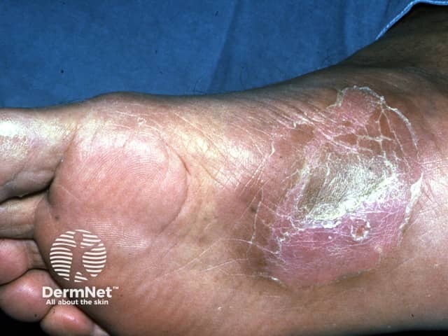 Cutaneous tuberculosis: Bazin disease