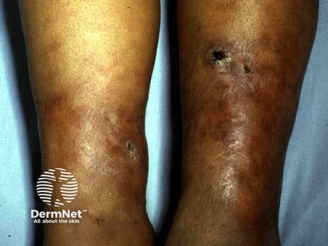 Cutaneous tuberculosis: Bazin disease