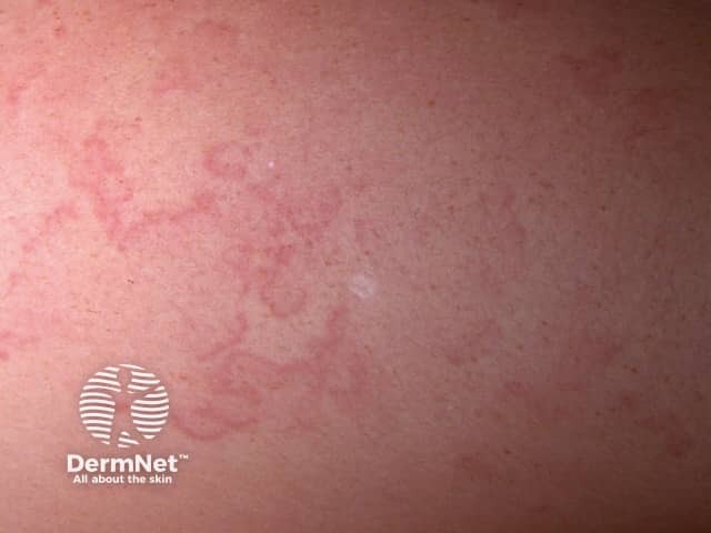 Erythema marginatum