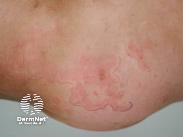 Erythema marginatum