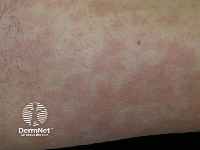 Erythema marginatum