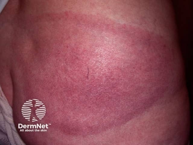 Erythema chronicum migrans