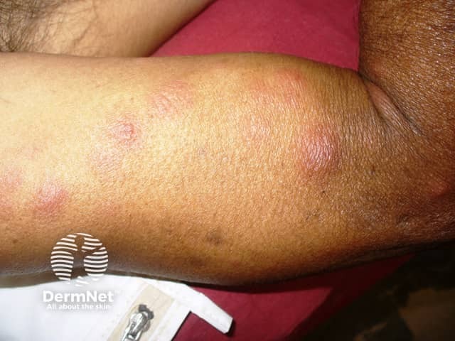 Erythema nodosum leprosum