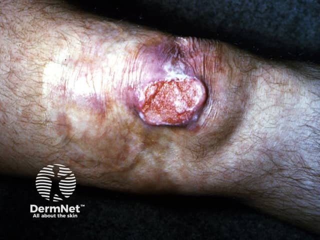 Lupus vulgaris with squamous cell carcinoma