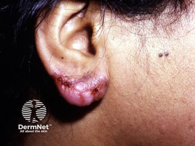 Cutaneous tuberculosis: lupus vulgaris