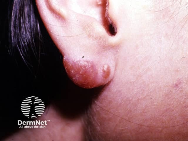 Cutaneous tuberculosis: lupus vulgaris