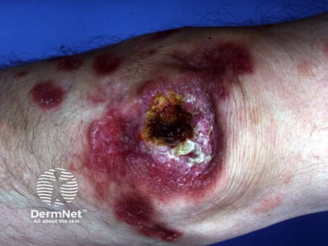 Cutaneous tuberculosis: lupus vulgaris