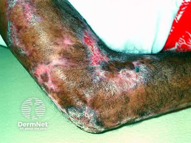 Cutaneous tuberculosis: lupus vulgaris