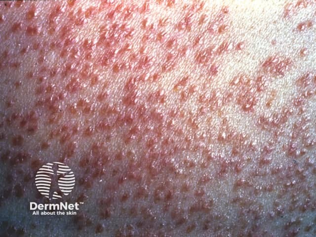 Cutaneous miliary tuberculosis