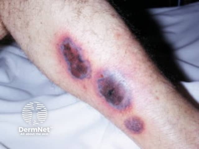 Ecthyma gangrenosum due to Pseudomonas septicaemia