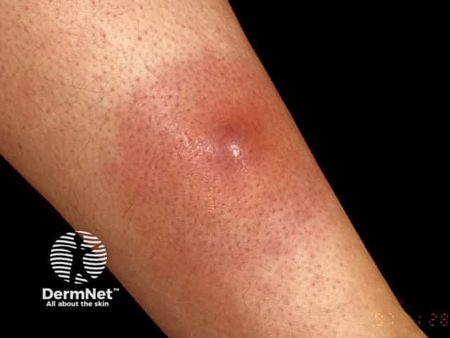 Surrounding cellulitis