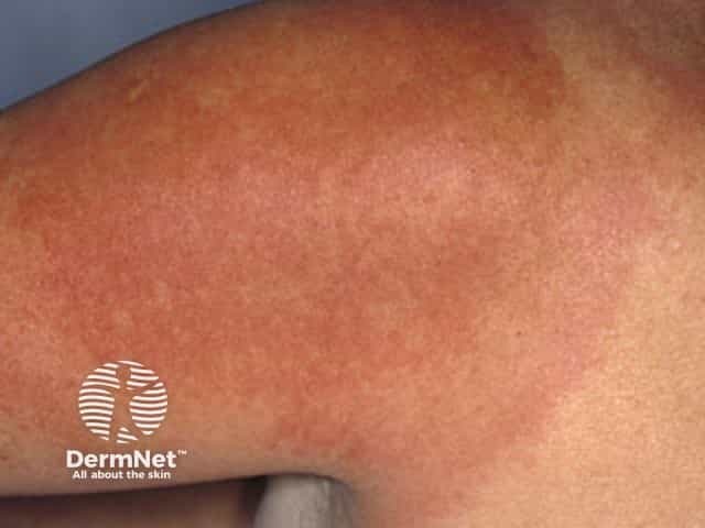 Erythema chronicum migrans