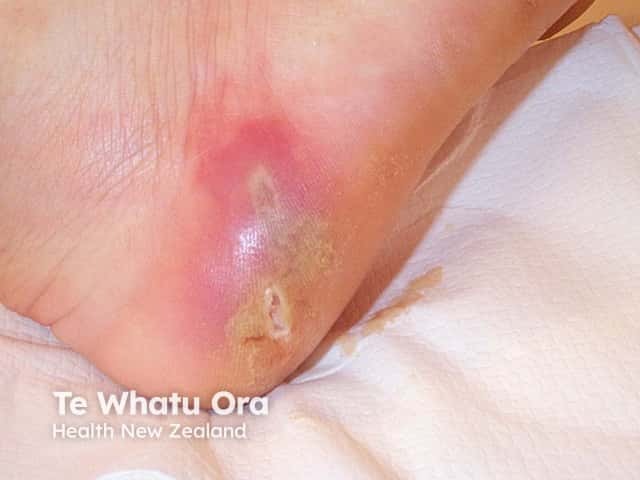 Wound infection