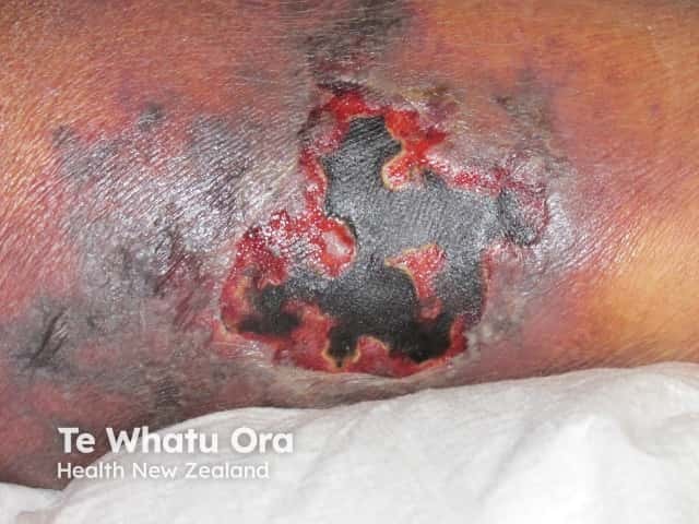 Necrotising cellulitis