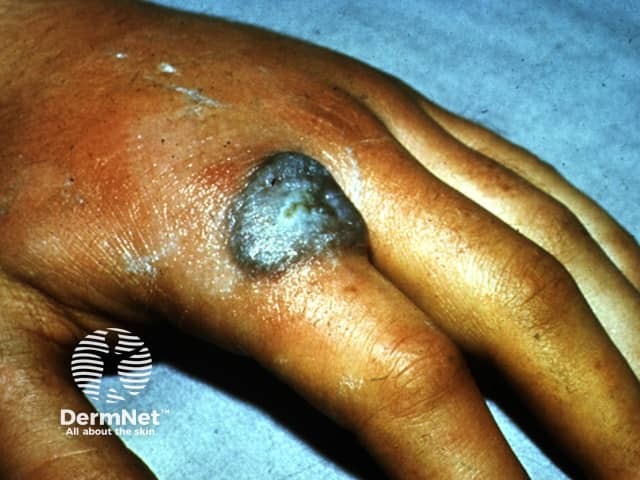 Cutaneous tuberculosis/warty tuberculosis