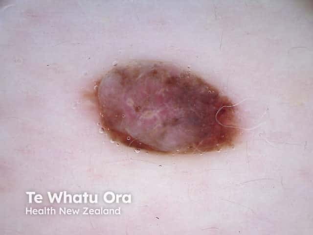 Dermatoscopy of BAP-oma