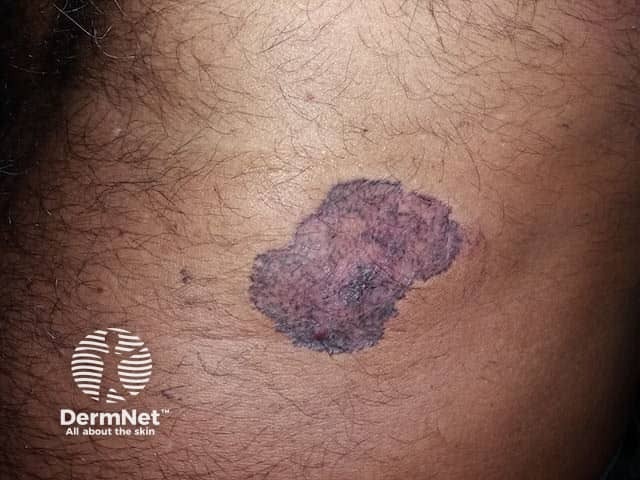 Superficial basal cell carcinoma