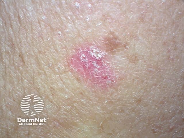 Superficial basal cell carcinoma 2 macro