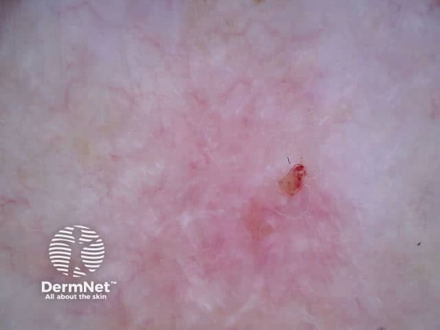 Superficial basal cell carcinoma 3 dermoscopy