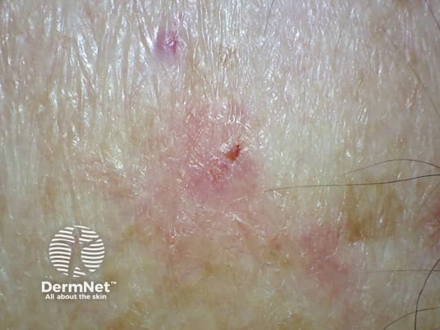 Superficial basal cell carcinoma 3 macro