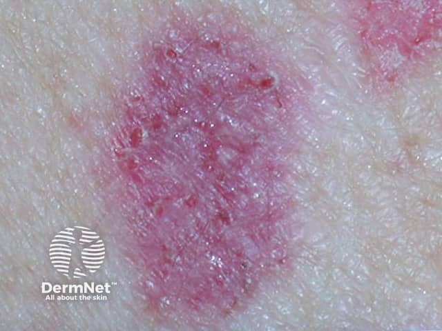 Superficial basal cell carcinoma 4 macro